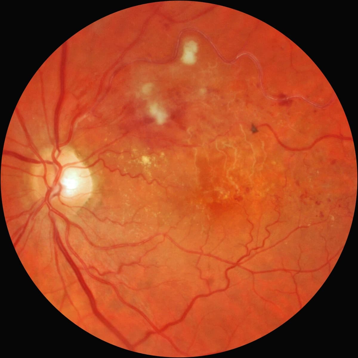 Fundus photograph showing a branch retinal vein occlusion