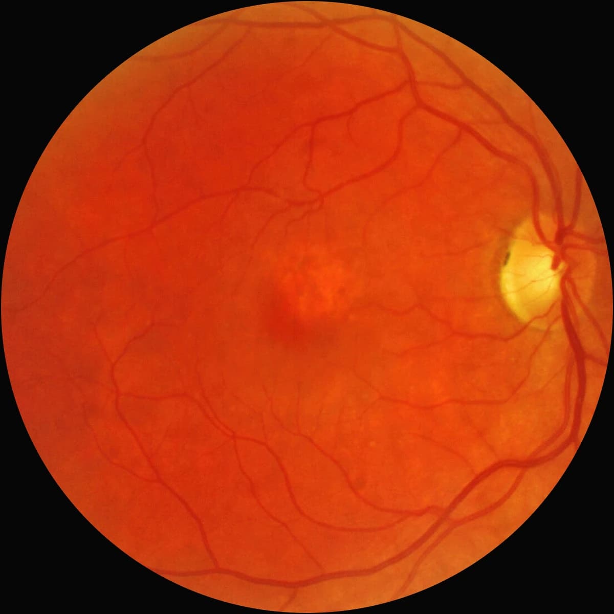 Color fundus photograph of a right eye