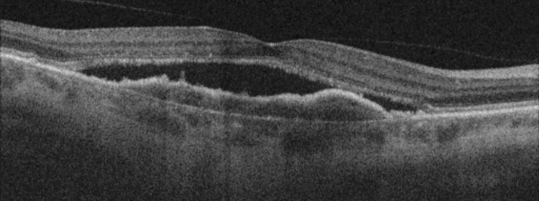 OCT B-scan: Pigment epithelial detachment with subretinal fluid